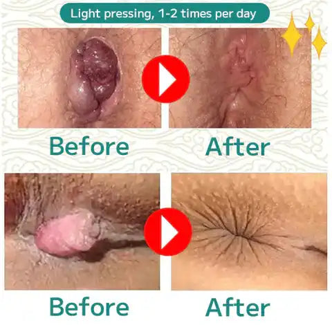Natural Forces Hemorrhoids Capsules